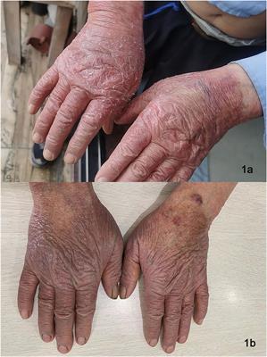 Clearance of Chronic Actinic Dermatitis With Dupilumab Therapy in Chinese Patients: A Case Series